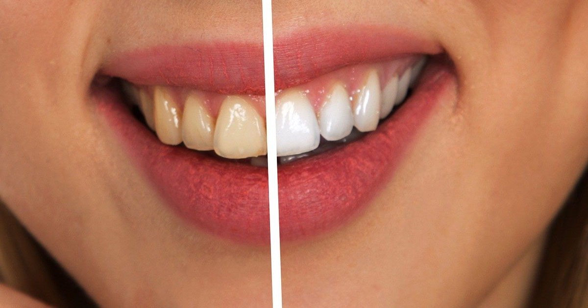 get-your-teeth-eight-shades-whiter