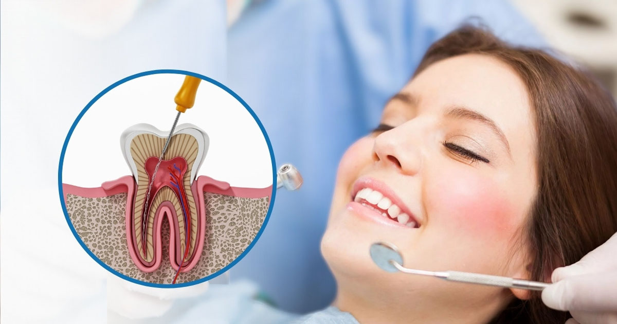 how-long-is-a-single-sitting-root-canal-treatment