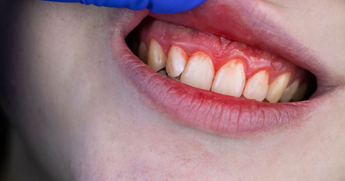 spotting-the-warning-signs-of-gum-disease