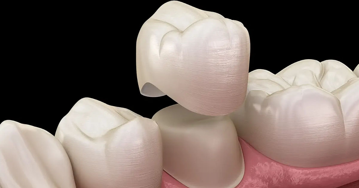 what-are-the-benefits-of-cerec-crowns