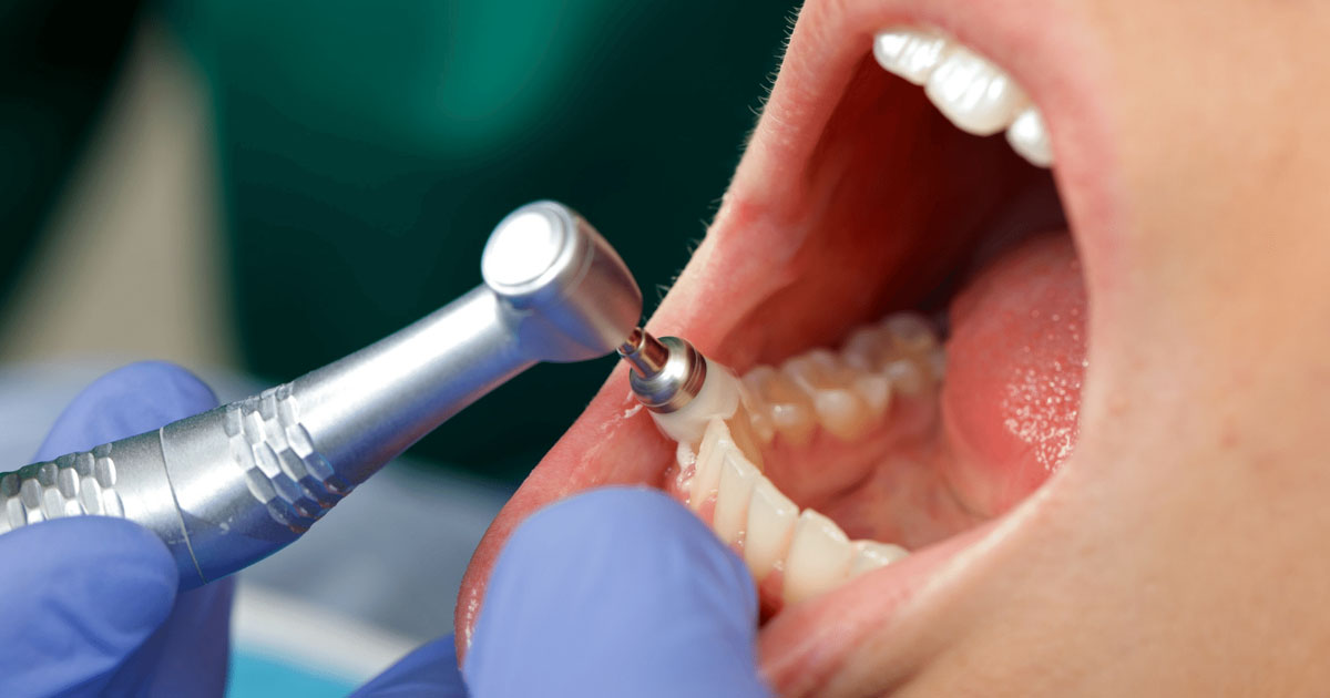 why-is-regular-dental-cleaning-important